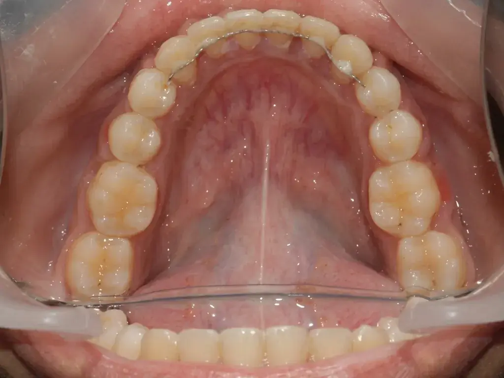 Lower Arch Orthodontics — After