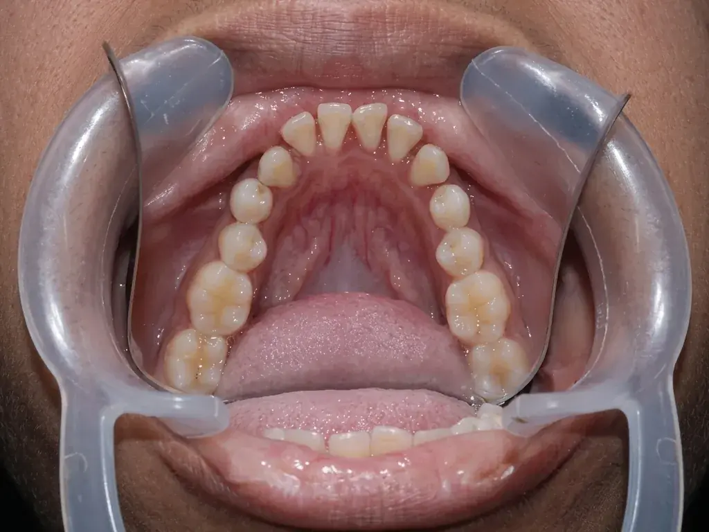 Lower Arch Orthodontics — Before