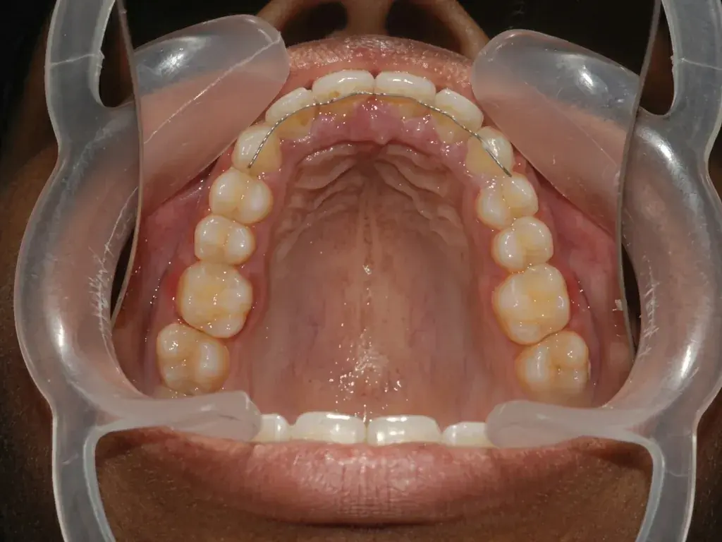 Orthodontic Realignment — After