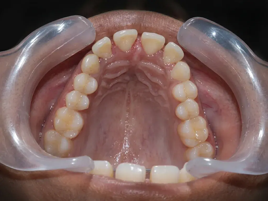 Orthodontic Realignment — Before