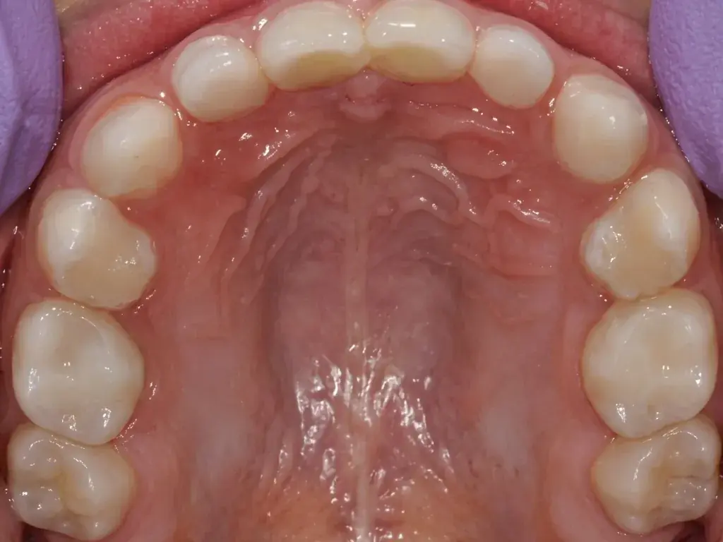 Pediatric Cavity Restoration — After