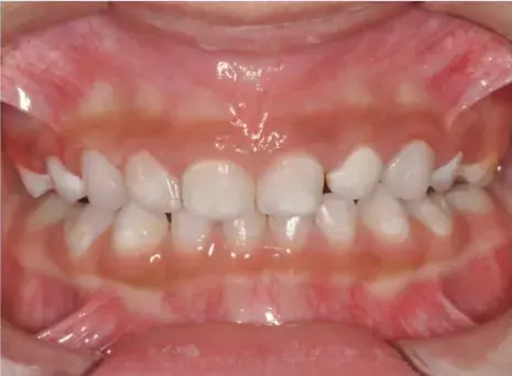 Pediatric Cavity Treatment — After