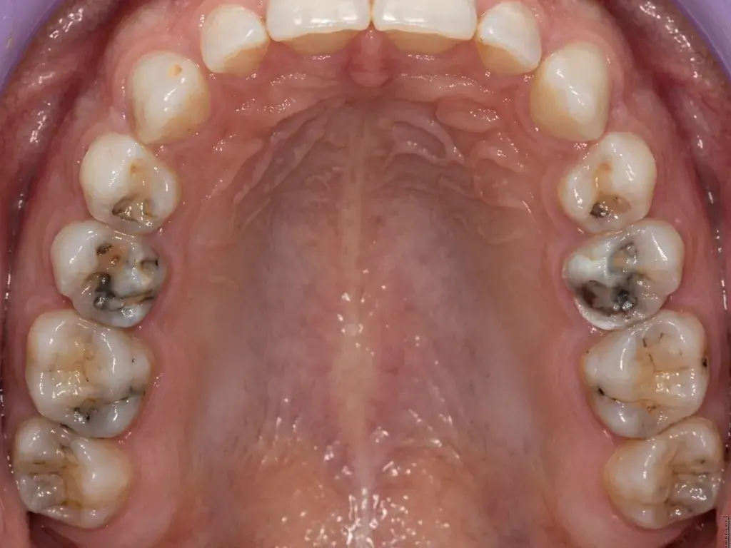 Pediatric Cavity Restoration — Before
