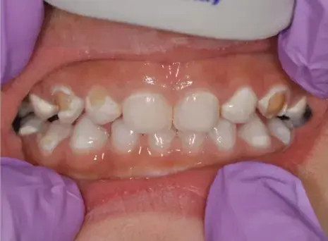 Pediatric Cavity Treatment — Before