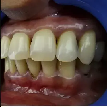 Front Tooth Cavity Restoration — After