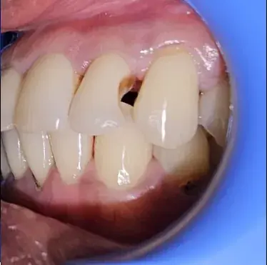 Front Tooth Cavity Restoration — Before
