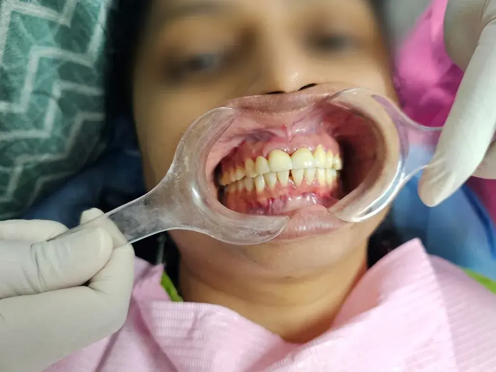 Smile Makeover & Veneers — After