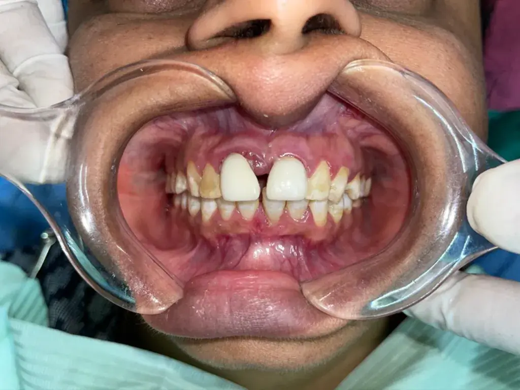 Smile Makeover & Veneers — Before