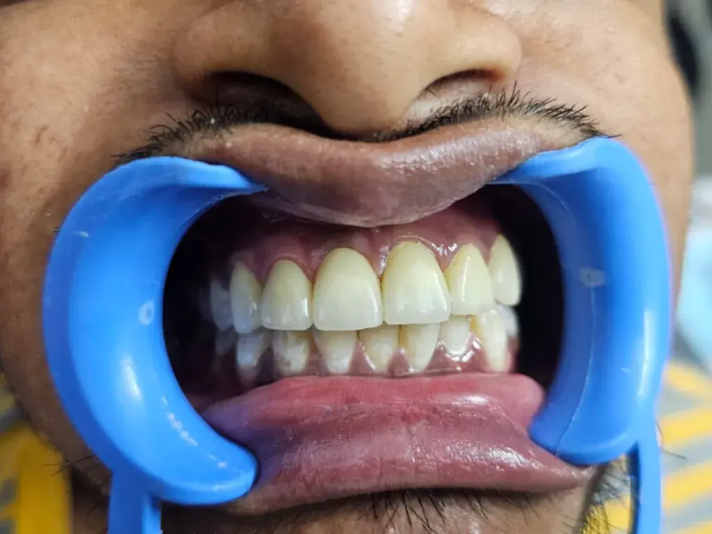 Anterior Aesthetic Veneers — After