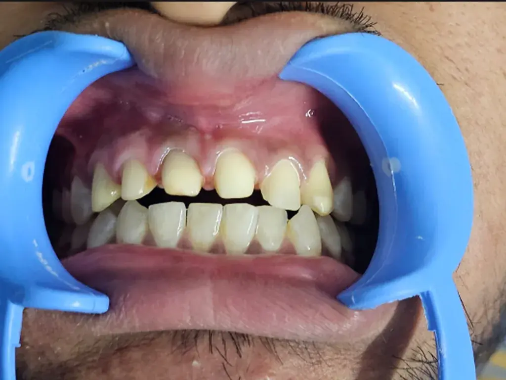 Anterior Aesthetic Veneers — Before