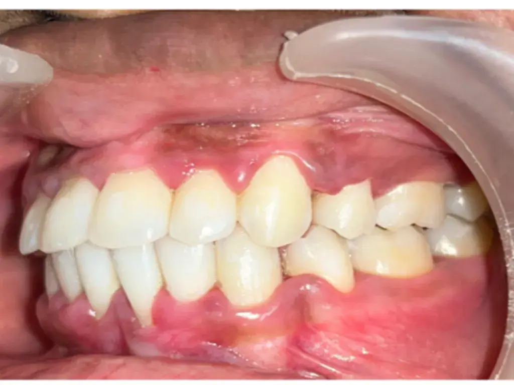 Orthodontic Overjet Correction — After