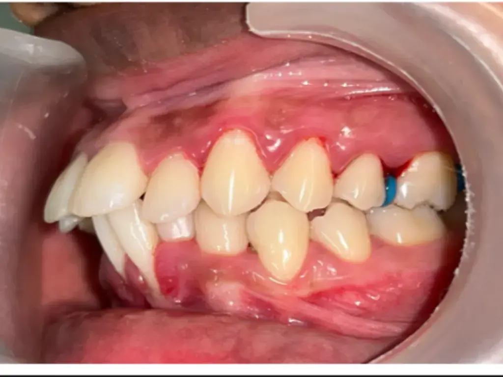 Orthodontic Overjet Correction — Before