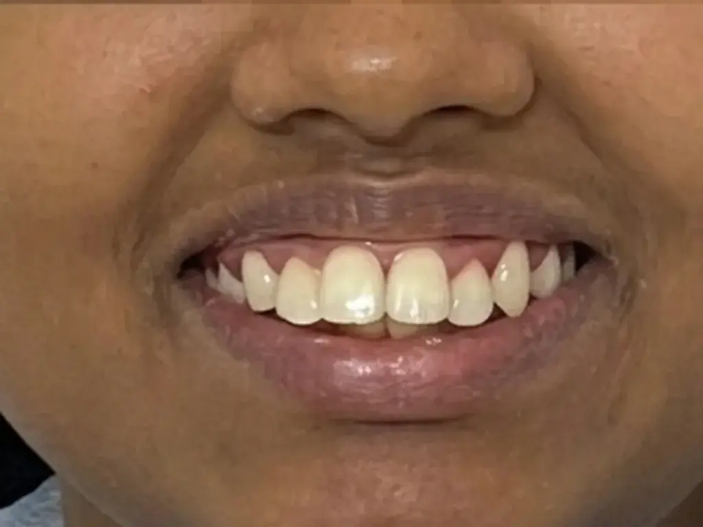 Gummy Smile & Veneers — After