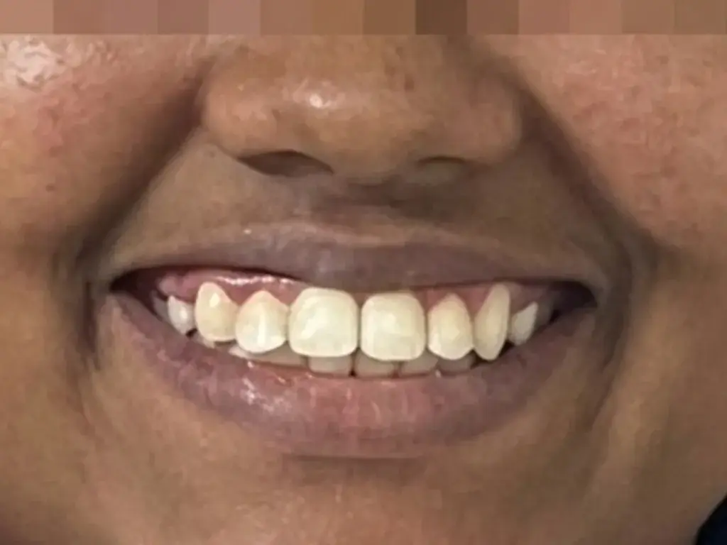 Gummy Smile & Veneers — Before